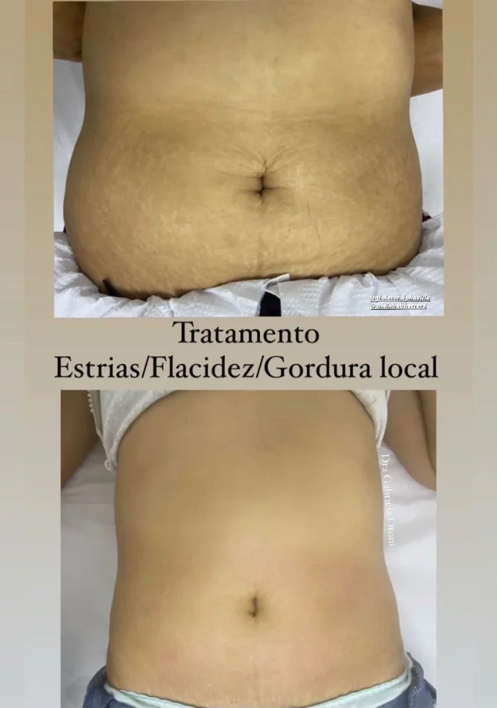 Comparação de evolução em tratamento corporal para estrias, flacidez e gordura localizada
