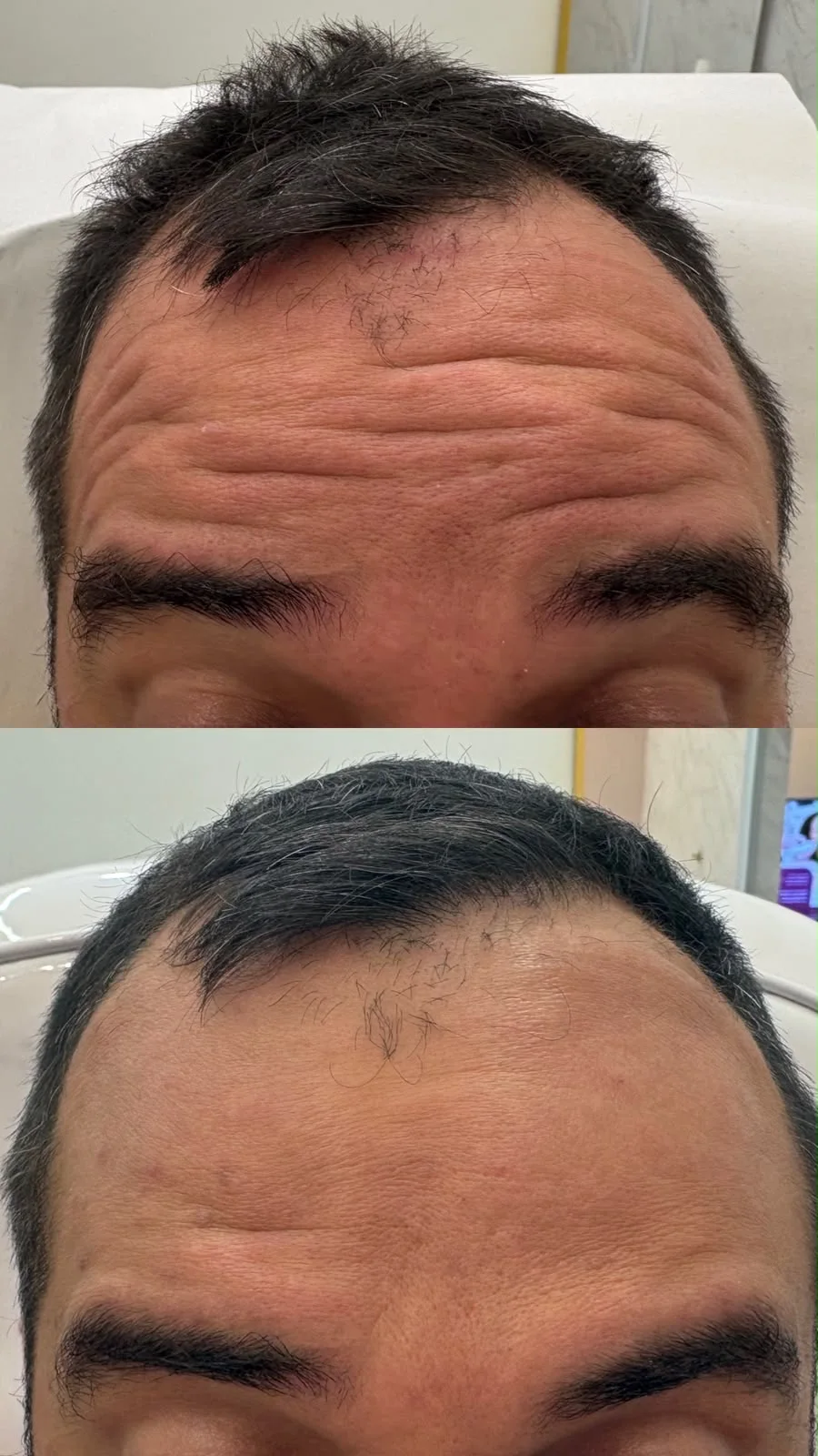 Comparação da região da testa antes e depois de tratamento facial