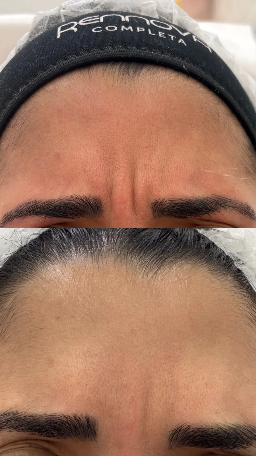Comparação da região da testa antes e depois de tratamento facial