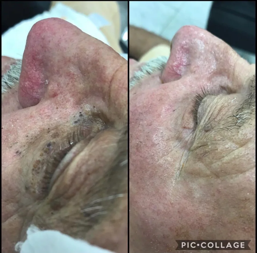Comparação da pele antes e depois de limpeza de pele