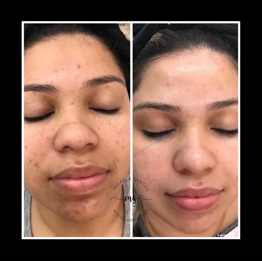 Comparação da pele antes e depois de tratamento facial